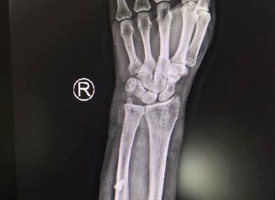 大猪发狂妻子伸手救丈夫 结果右臂被严重咬伤……