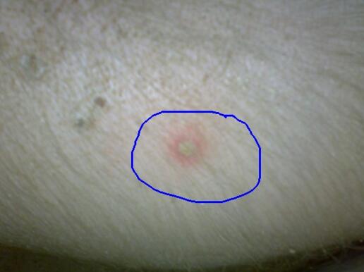 技术|猪身体出现的脓包如何处置？