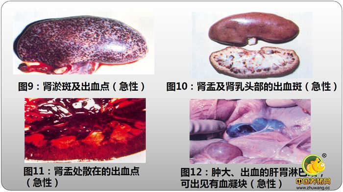 肾淤斑及出血点（急性）